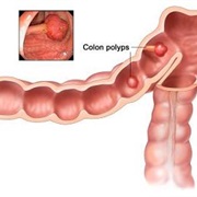 Colon Polyp