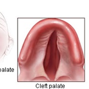 Cleft Palate