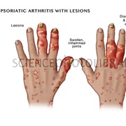 Psoriatic Arthritis