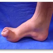 Charcot-Marie-Tooth Disease