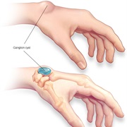 Ganglion Cyst