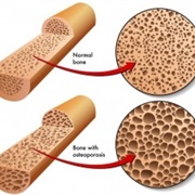 Osteoporosis