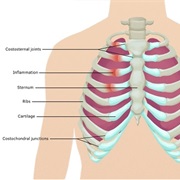 Costochondritis