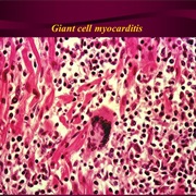 Giant Cell Myocarditis