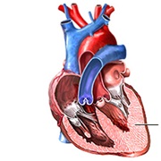 Cardiomyopathy