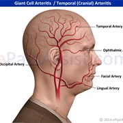 Giant Cell Arteritis (Temporal Arteritis)