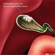 Gallbladder Cancer