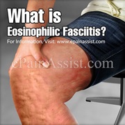 Eosinophilic Fasciitis