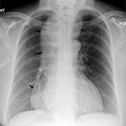 Achalasia