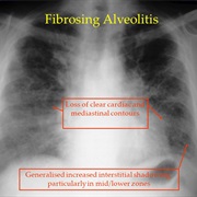 Fibrosing Alveolitis