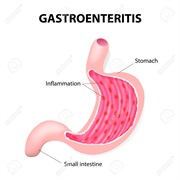 Gastroenteritis