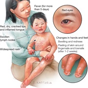 Kawasaki Disease