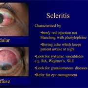 Scleritis