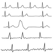 Arrhythmia