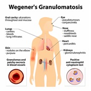 Granulomatosis With Polyangiitis