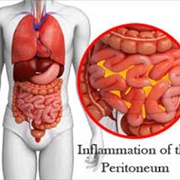 Peritonitis