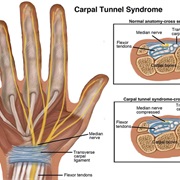 Carpal Tunnel Syndrome