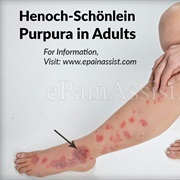 Henoch-Schonlein Purpura (HSP)