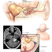 Acoustic Neuroma (Vestibular Schwannoma)