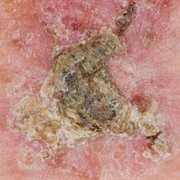 Actinic Keratoses (Solar Keratoses)