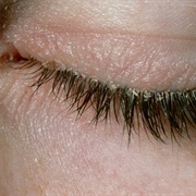 Blepharitis