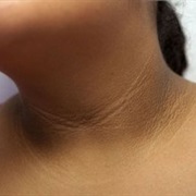 Acanthosis Nigricans