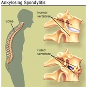 Ankylosing Spondylitis