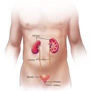 Bladder Stones