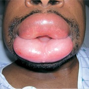 Angioedema