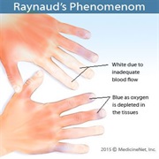 Raynaud&#39;s Phenomenon