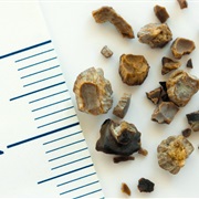 Kidney Stone