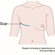 Mastectomy