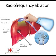 Liver Ablation