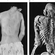 Fibrodysplasia Ossificans Progressiva