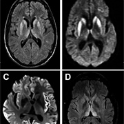 Creutzfeldt-Jakob Disease