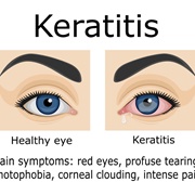 Keratitis