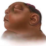 Anencephaly