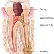 Had a Root Canal Done