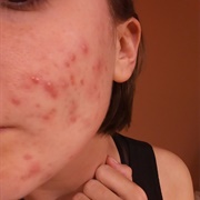 Acne Sufferer