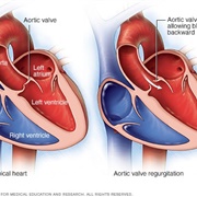 Missing Heart Valve