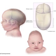 Craniosynostosis