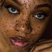 Freckles