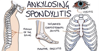 Notable People With Ankylosing Spondylitis